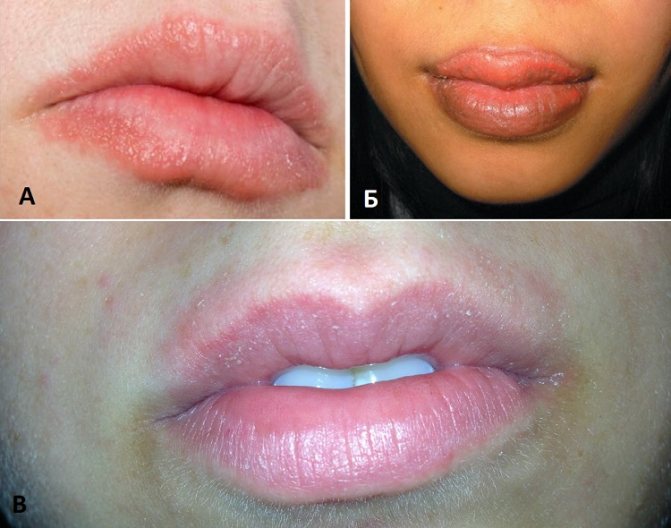 Аллергическая реакция на губах на помаду, бальзам и татуаж