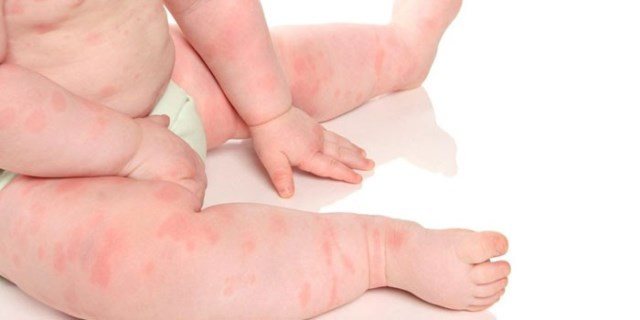 Аллергическая сыпь на ножках у ребенка фото с пояснениями