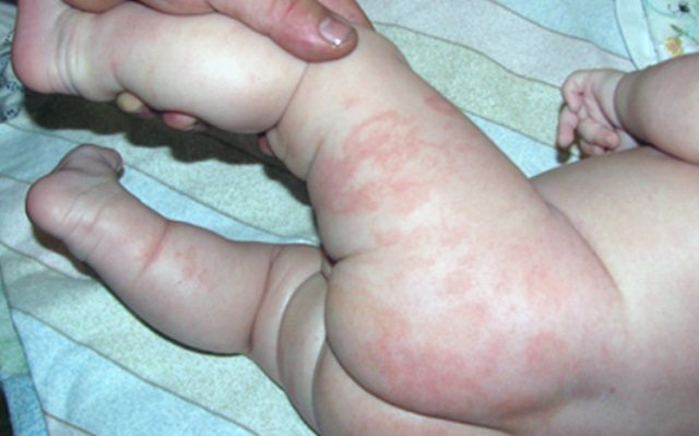 Аллергическая сыпь на ножках у ребенка фото с пояснениями