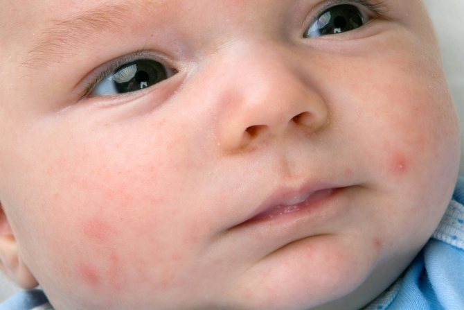 аллергические проявления у ребенка