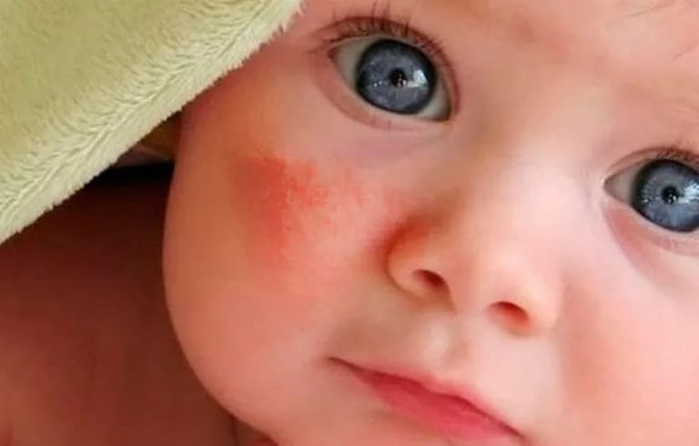 Allergic dermatitis on the bottom of a child