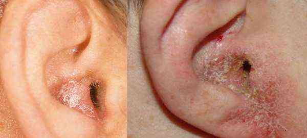 allergic ear dermatitis