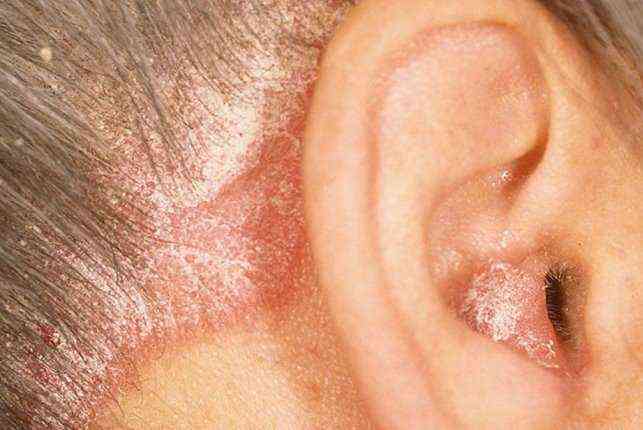 аллергический дерматит ушей