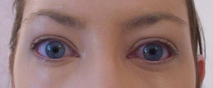 аллергия глаза чешутся и опухают чем лечить