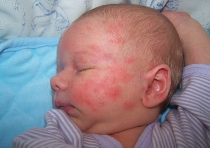 Аллергия на бактерии у ребенка