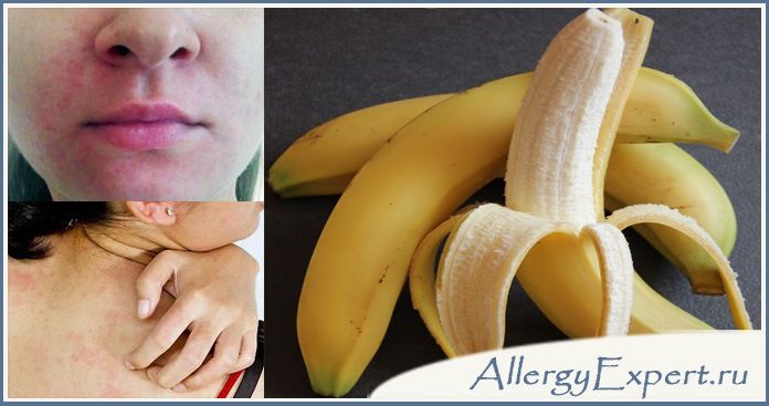 аллергия на бананы у ребенка симптомы