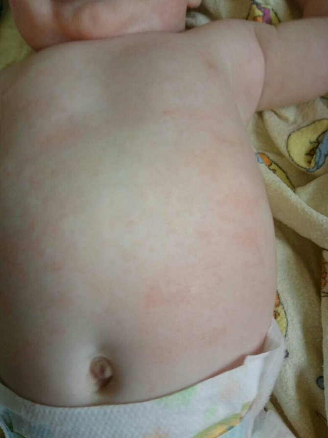 Allergy to BKM at 1 month of breastfeeding