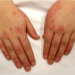 Аллергия на бытовую химию, симптомы