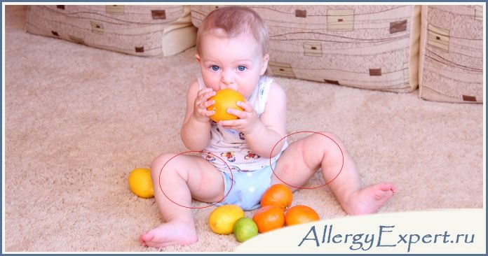 аллергия на цитрусовые у детей