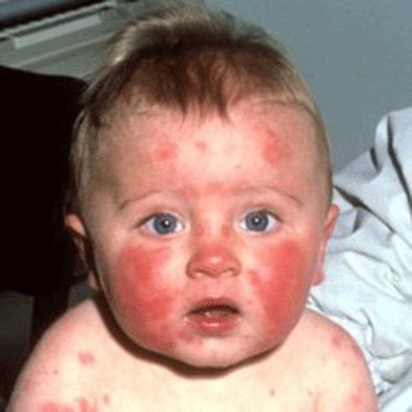 Аллергия на геркулес у взрослых