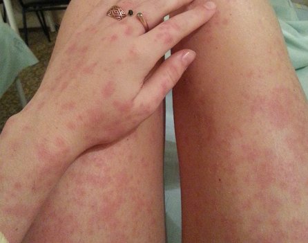 Аллергия на геркулес у взрослых