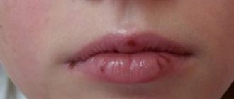 Аллергия на губах после лечения зуба