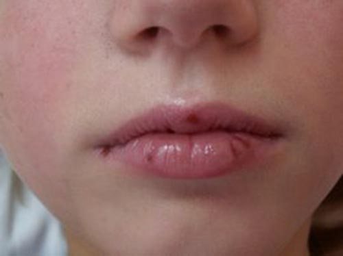 Аллергия на губах после лечения зуба