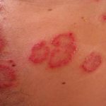 Аллергия на казеин: симптомы, методы лечения, как проявляется?