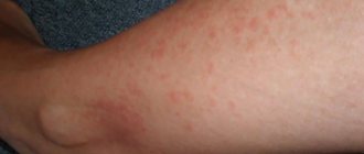 Аллергия на красную икру