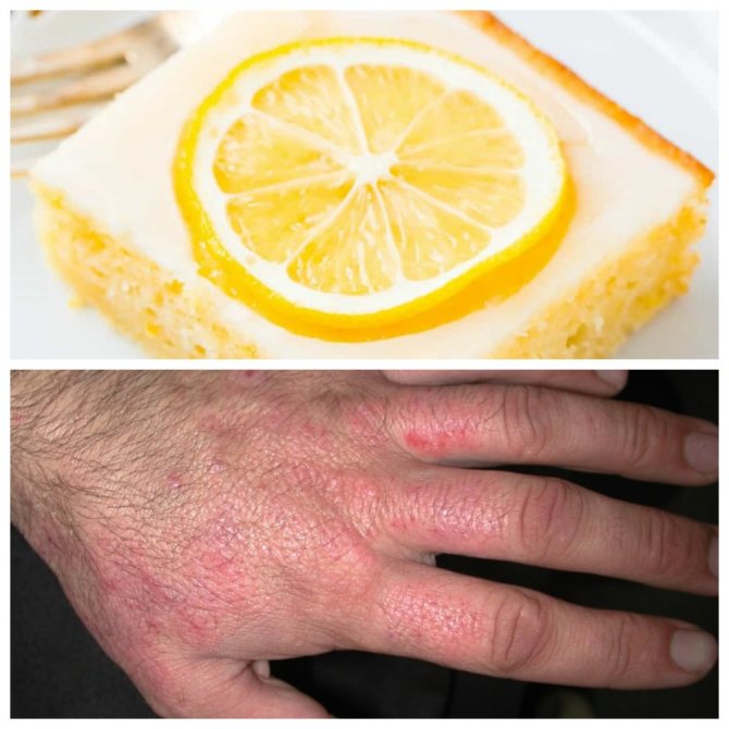 Аллергия на лимон - распространенный вид