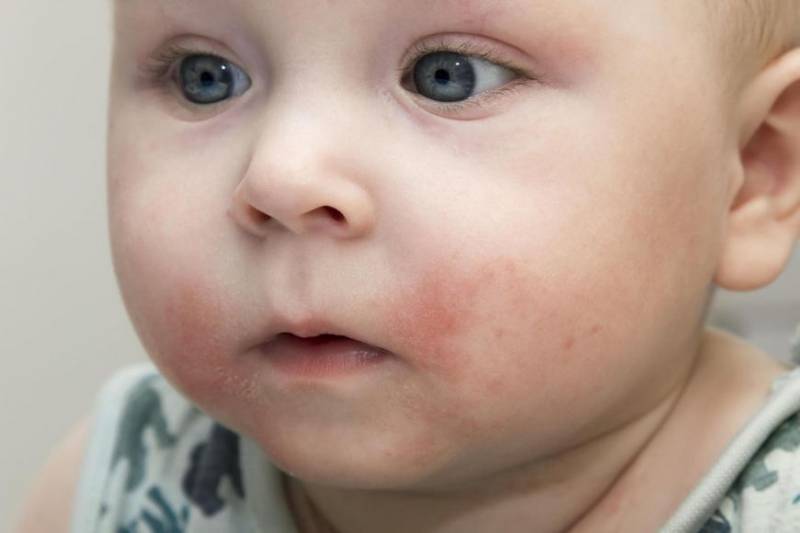 Аллергия на мыло: возможные причины, проведение диагностических исследований, лечение