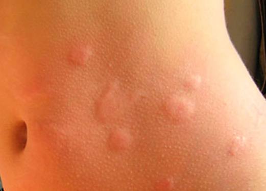 Аллергия на отраву для тараканов — Аллергия