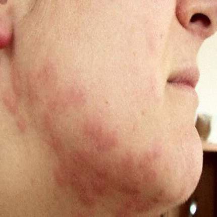 аллергия на пыль на клещи как лечить