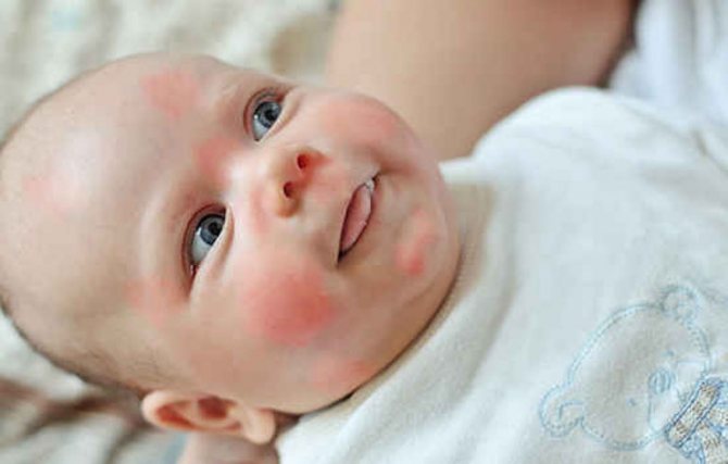 аллергия на щеках у грудных детей