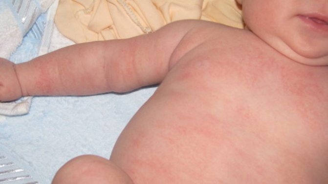 allergy to washing powder in infants