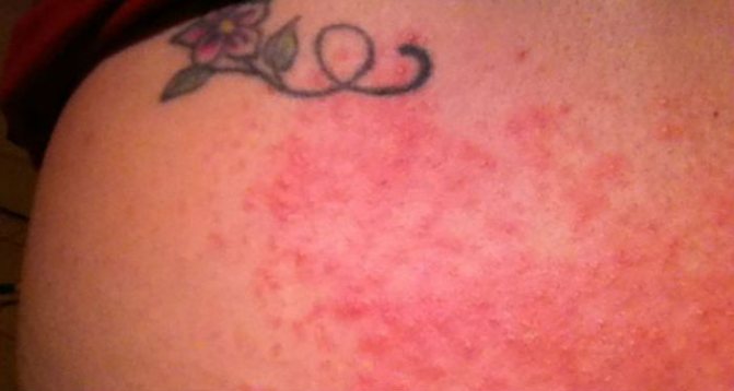 Allergy to bedbug bite