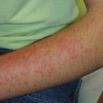 Аллергия на вакцину