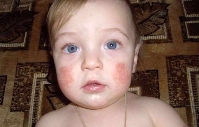 Аллергия на витамин Д у ребенка