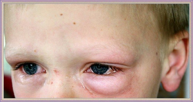 аллергия под глазами у детей