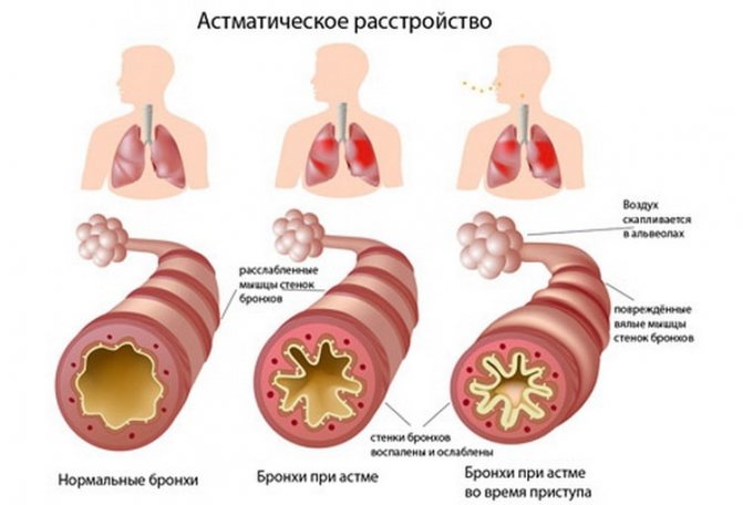 Бронхиальная астма у детей-серьезное заболевание которое требует постоянного контроля.