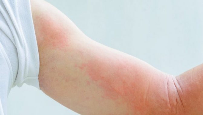 Бывает ли аллергия на йод? Как она проявляется у взрослых и детей? Методы лечения