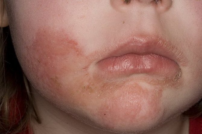 Чем отличается аллергия от атопического дерматита