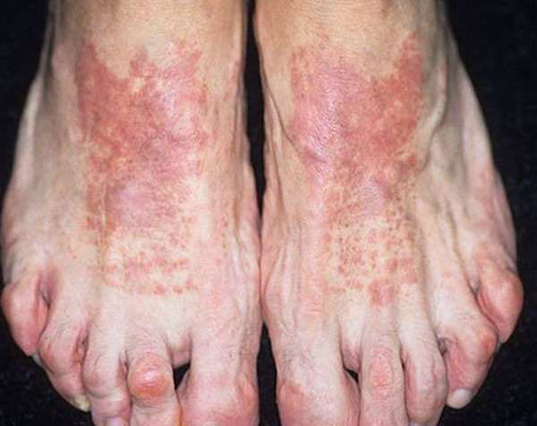 Dermatitis on the legs - photo, how to treat