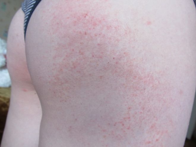 Dermatitis on the buttocks of an adult photo - Your allergy