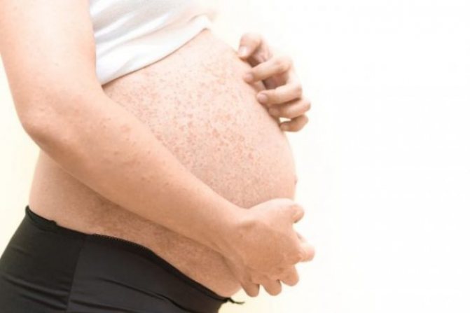 дерматит при беременности
