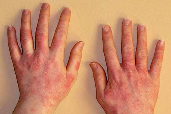Dry seborrheic dermatitis on hands