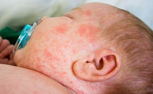 Seborrheic dermatitis in children photo