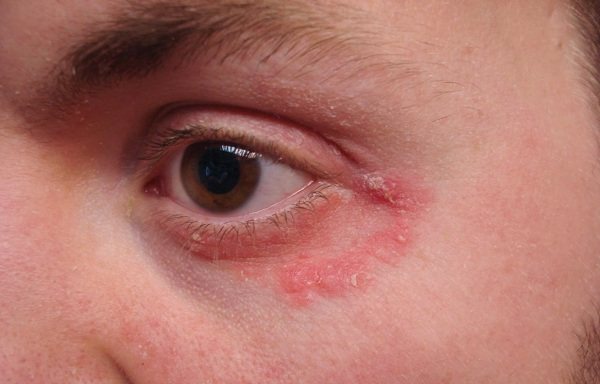 Eyelid dermatitis. Treatment, ointments and creams, photos, which doctor to go to 
