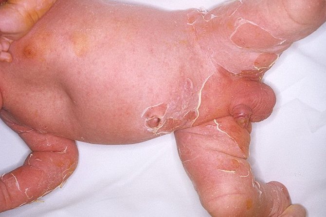 Эксфолиативный дерматит новорожденных