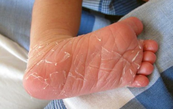 Эксфолиативный дерматит риттера у новорожденных