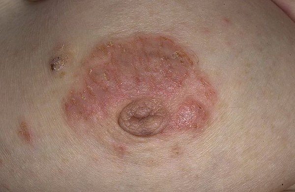 Microbial eczema of the nipples