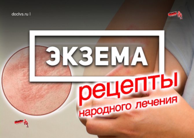 eczema folk treatment