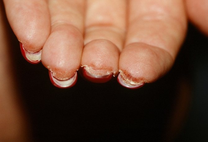 Еще одно проявление аллергии на пальцах