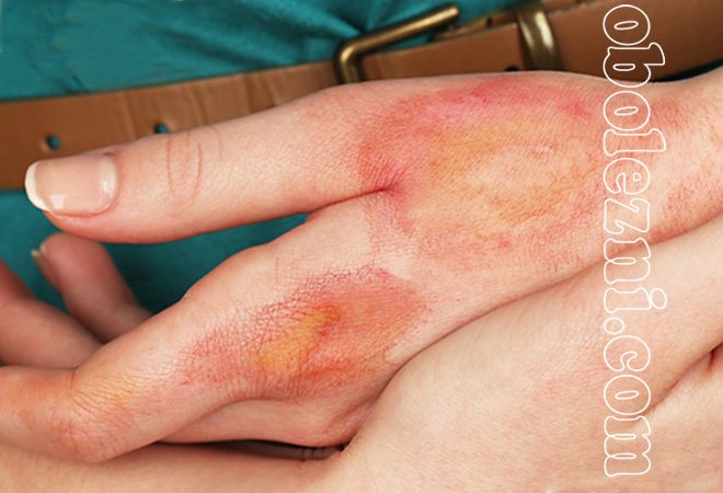 Фото дерматита на руках и ногах