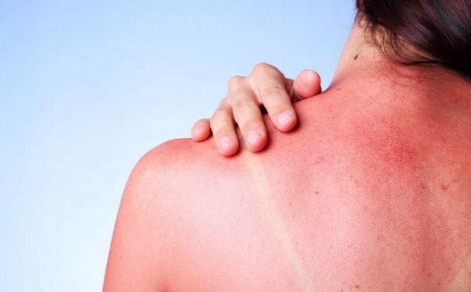 Фото как выглядит аллергия на солнце