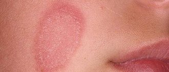Фото пятен на теле аллергия — Все про аллергию