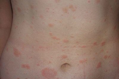 Фото пятен на теле аллергия — Все про аллергию