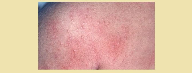 Фототоксическая реакция при аллергии на кожу