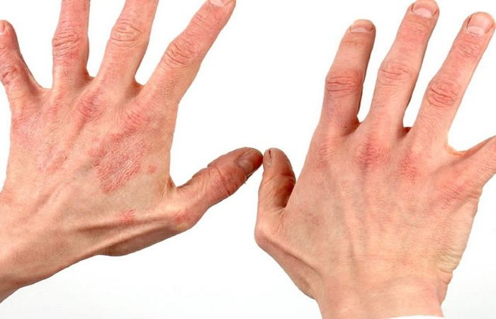 Холодовая аллергия на руках