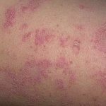 Хроническая болезнь, проявляющаяся шелушащимися и мокнущими красными пятнами, может поражать кожу человека независимо от возраста